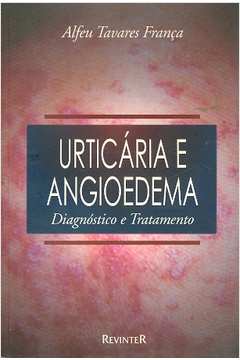 Urticária e Angioedema